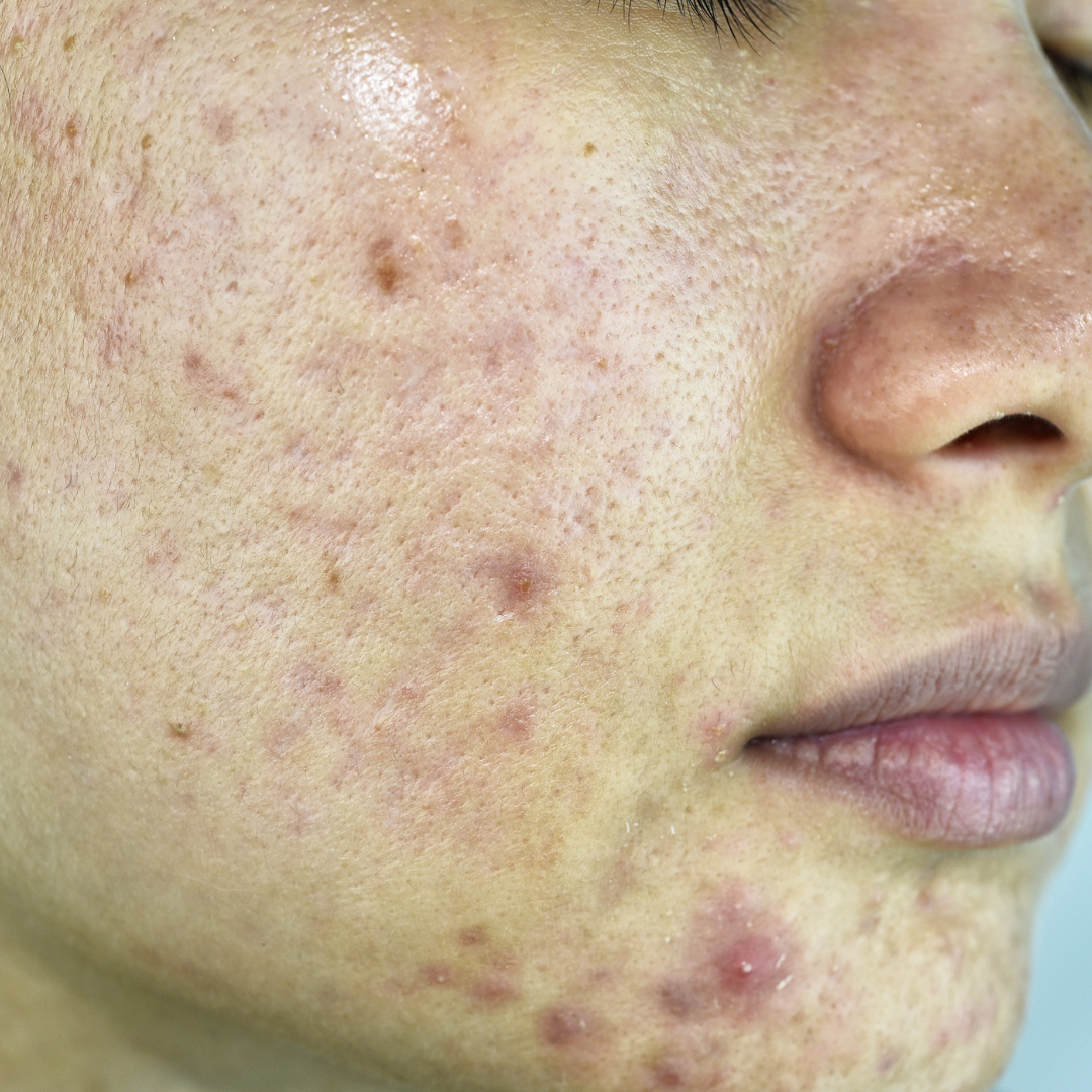 The Cause and Types of Acne: A Comprehensive Guide  Invigorate Spa